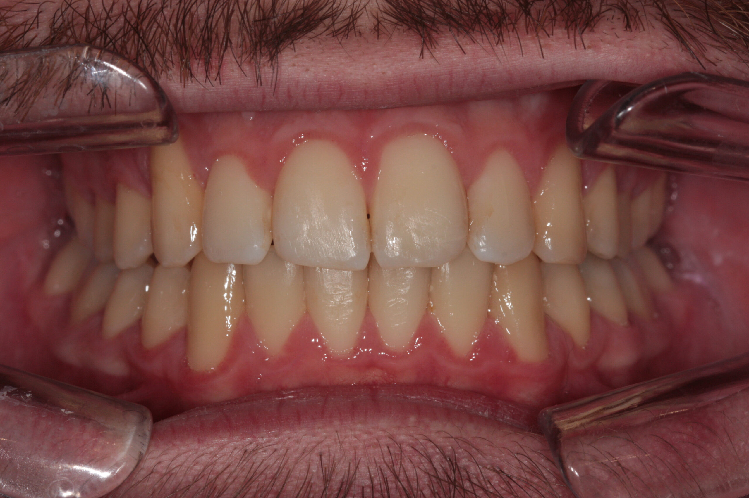Crowding - aligners after treatment