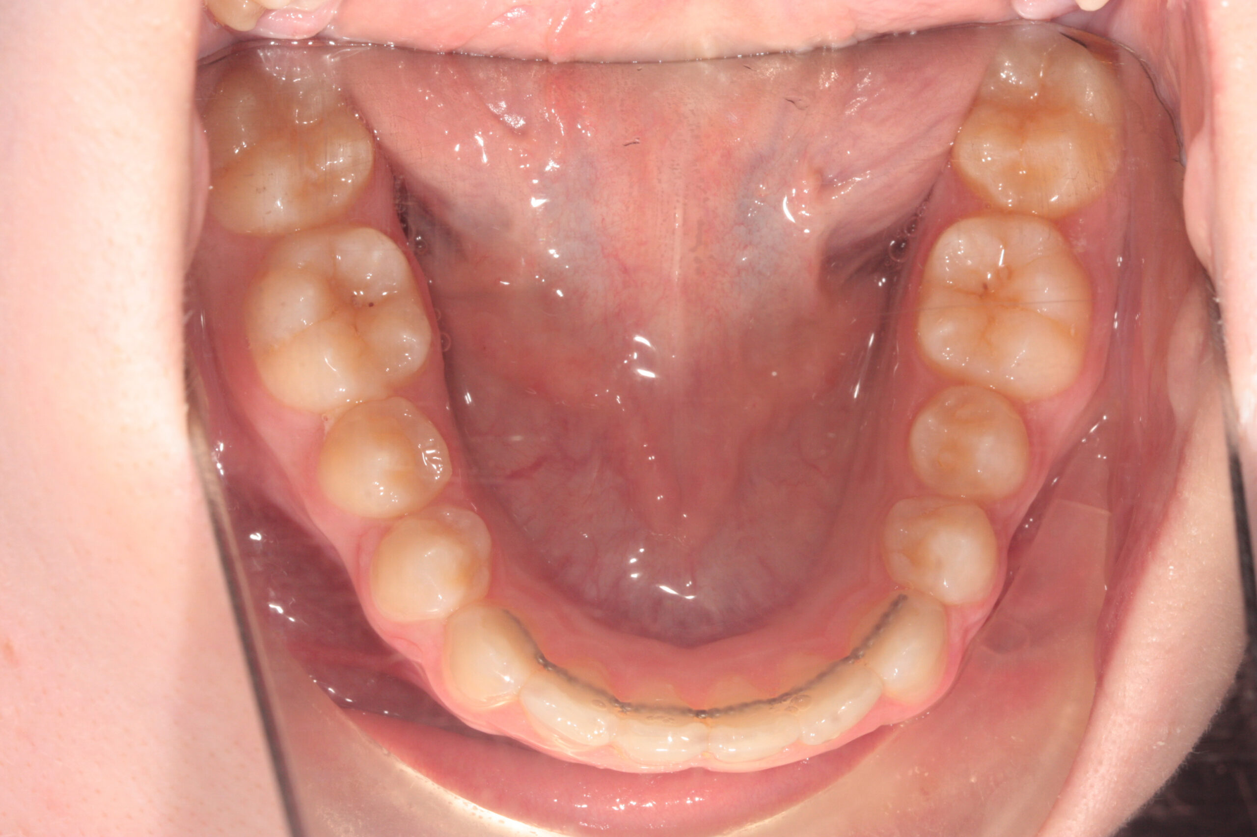 Crowding - aligners after treatment
