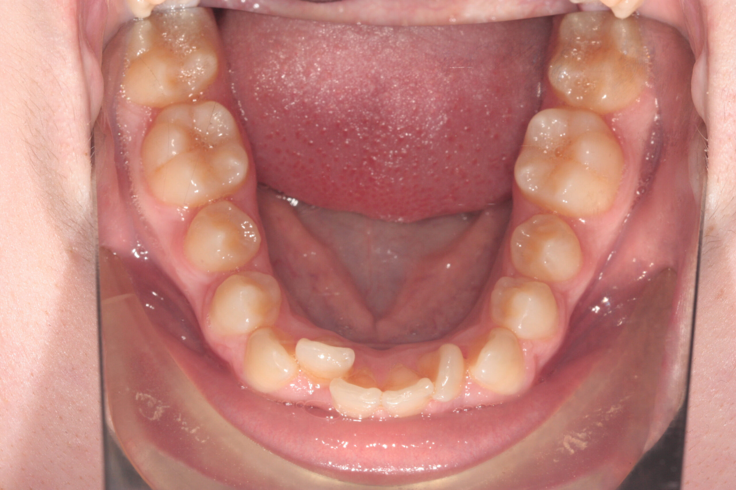 Crowding - aligners before treatment