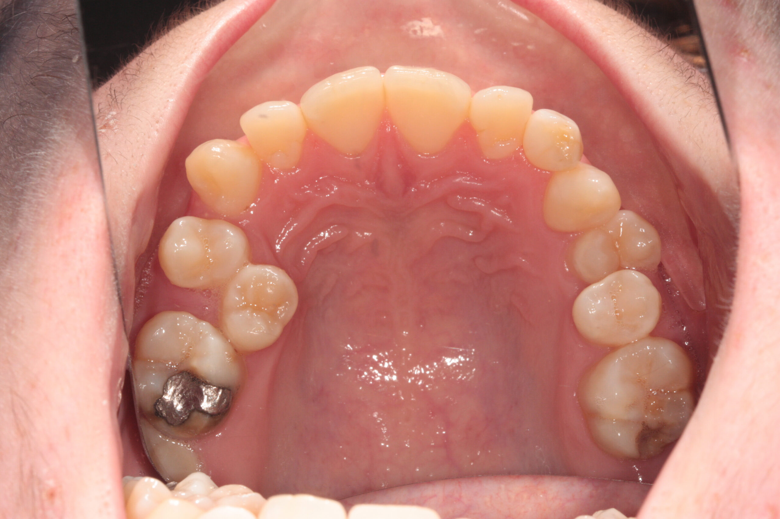Crowding - fixed braces before treatment