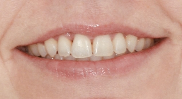 Crowding - fixed braces after treatment