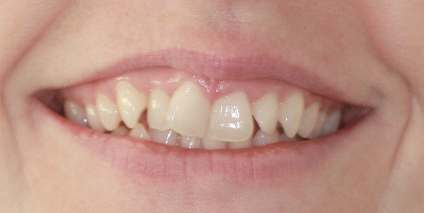 Crowding - fixed braces before treatment