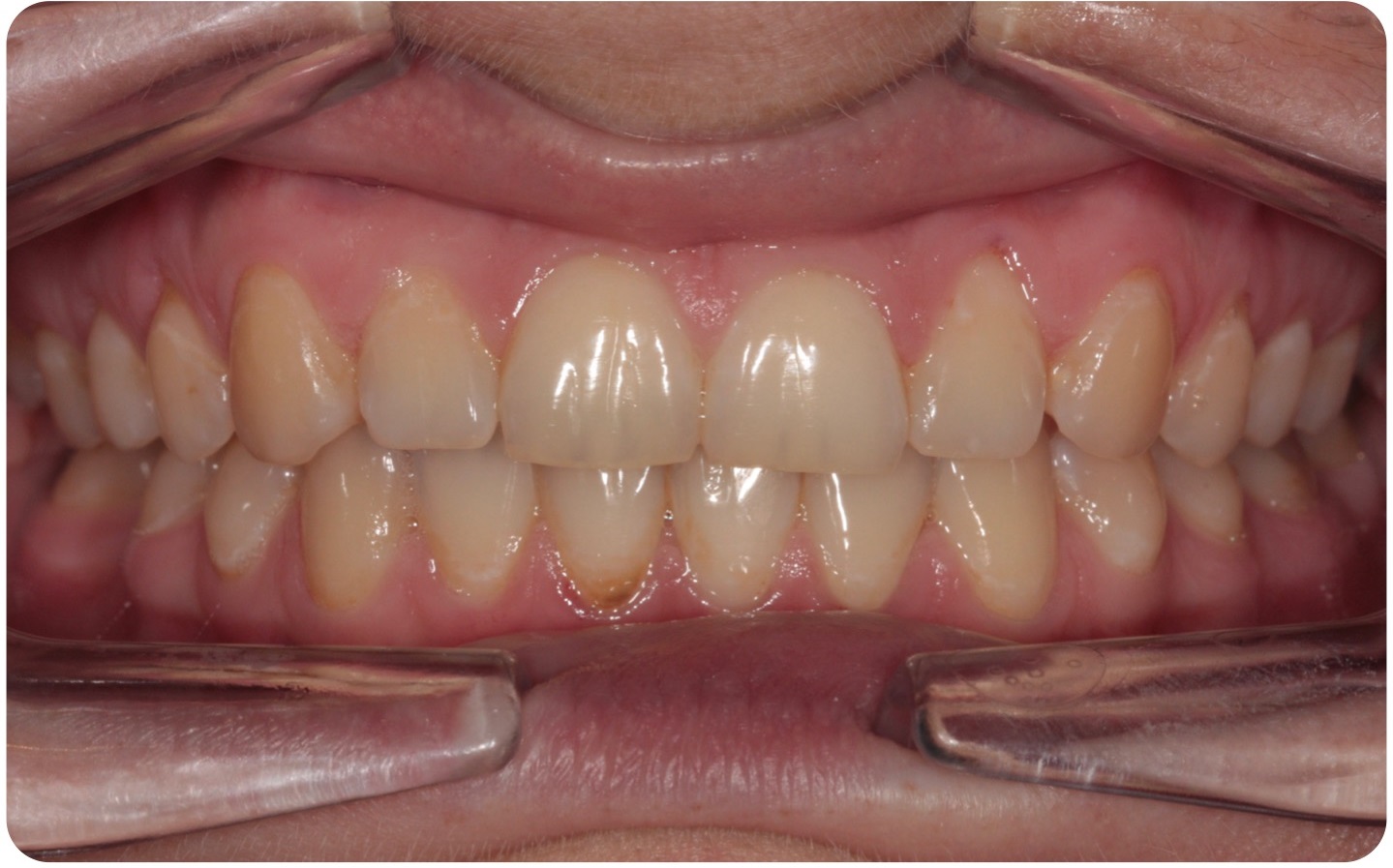 Deep bite - lingual braces after treatment