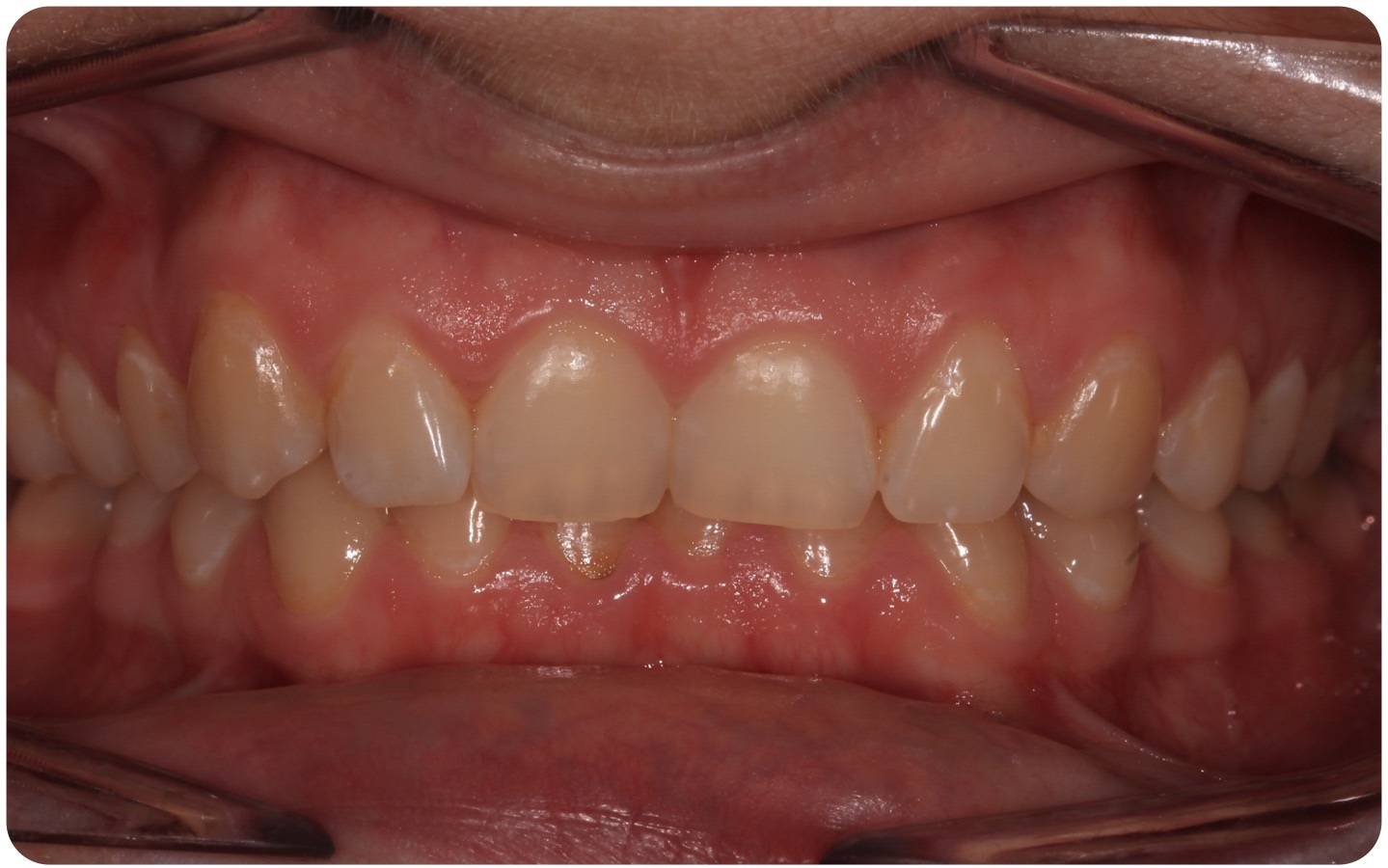 Deep bite - lingual braces before treatment
