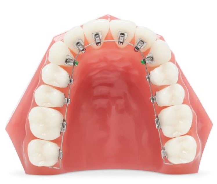 Lingual braces fitted behind teeth