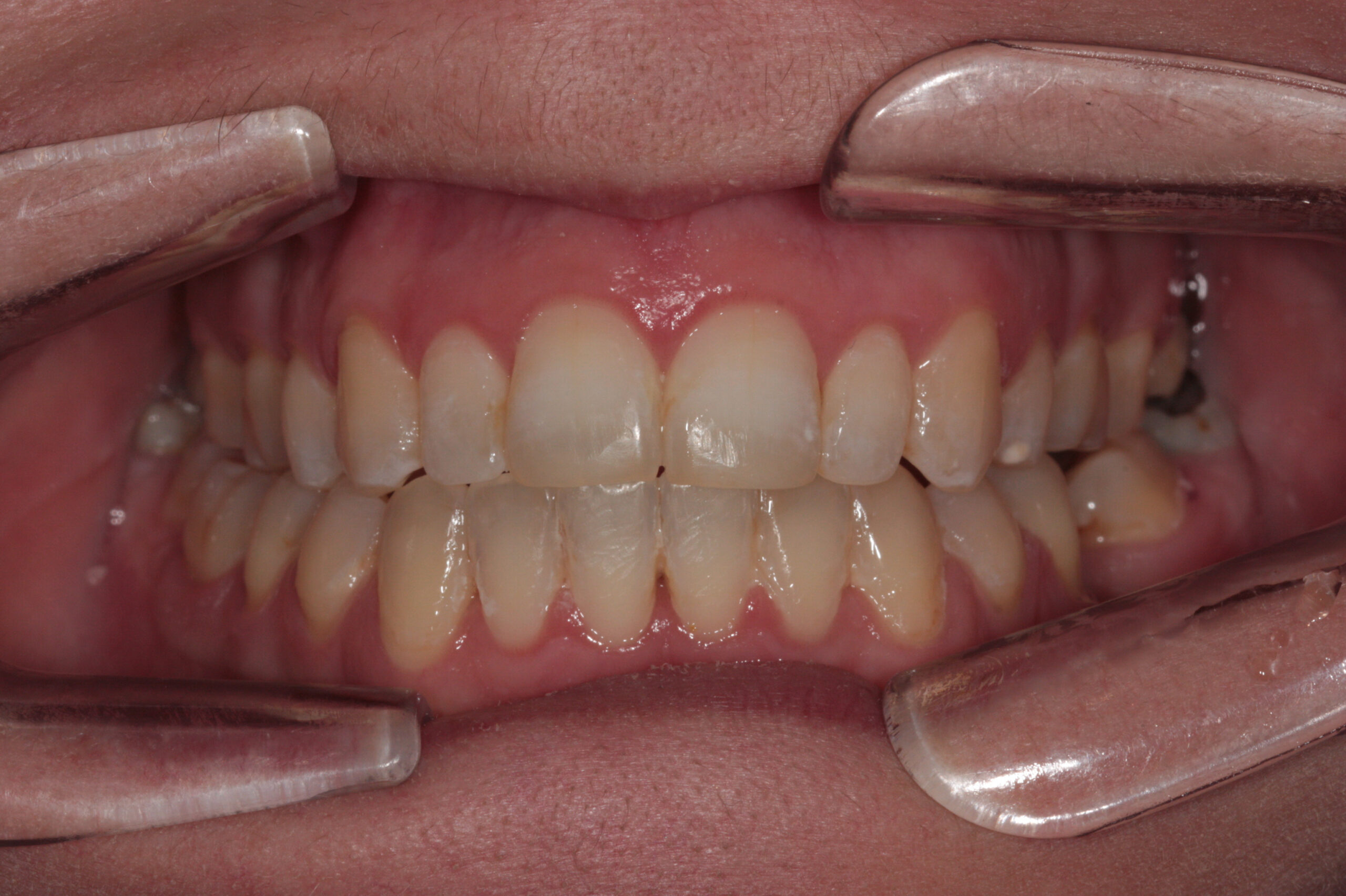 Open bite - fixed clear braces after treatment