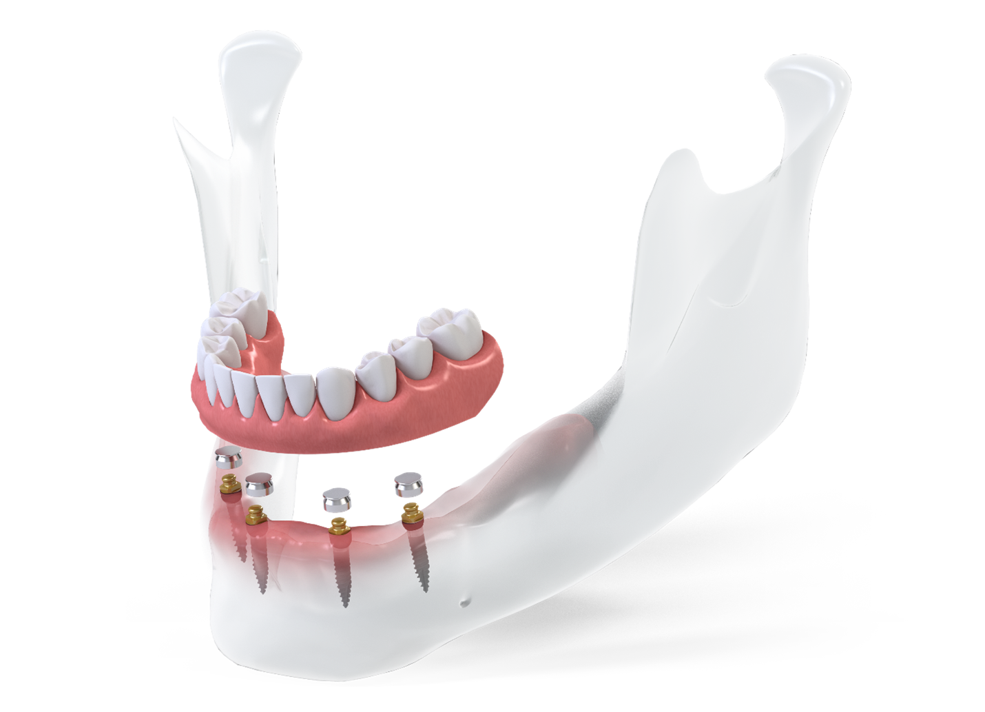 Full arch dental implant illustration