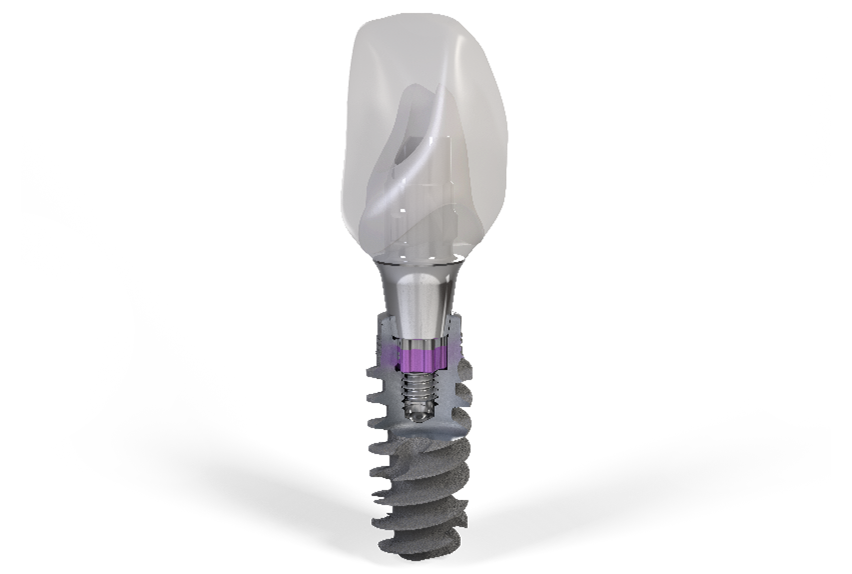 Single dental implant illustration