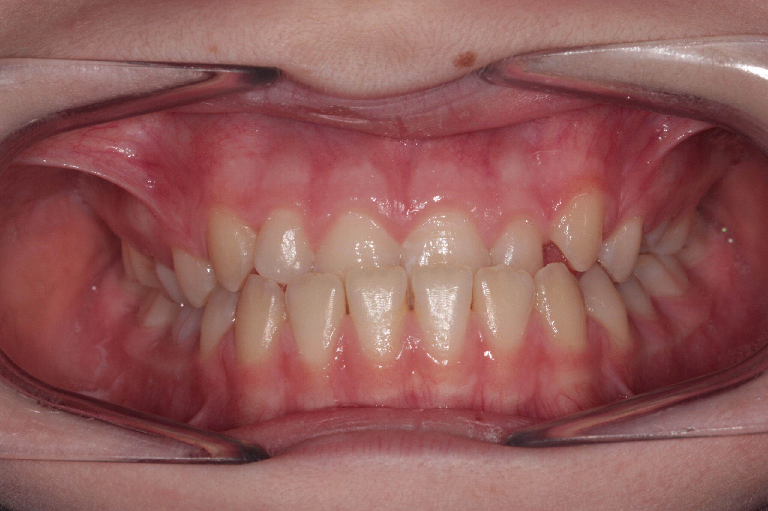 Crossbite - fixed braces before treatment