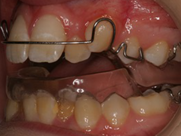 Orthodontic appliance model