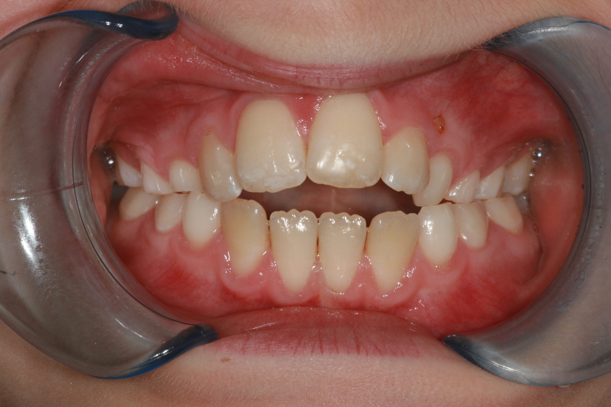 Open bite - interceptive aligners before treatment